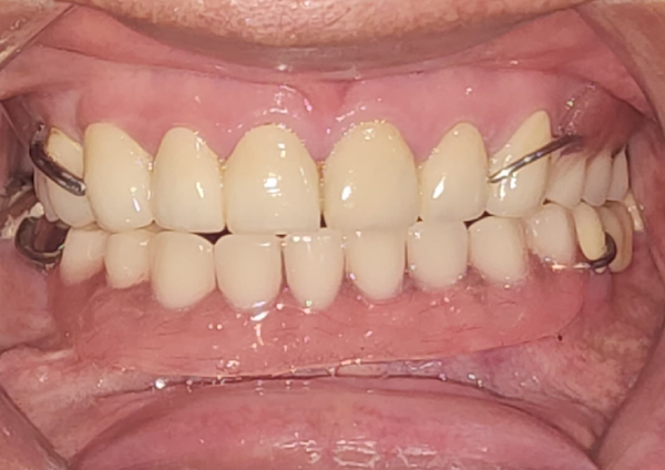 Root Canal Therapy - After